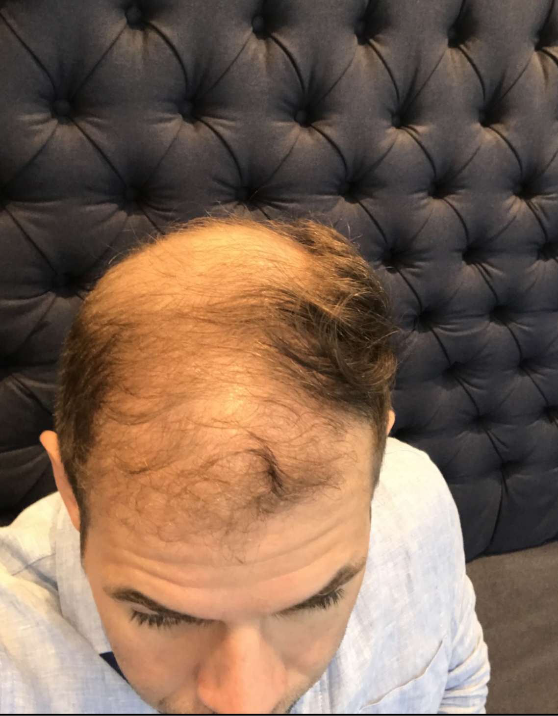 Dr. Charles Pereyra experiencing his own hair loss before treatment