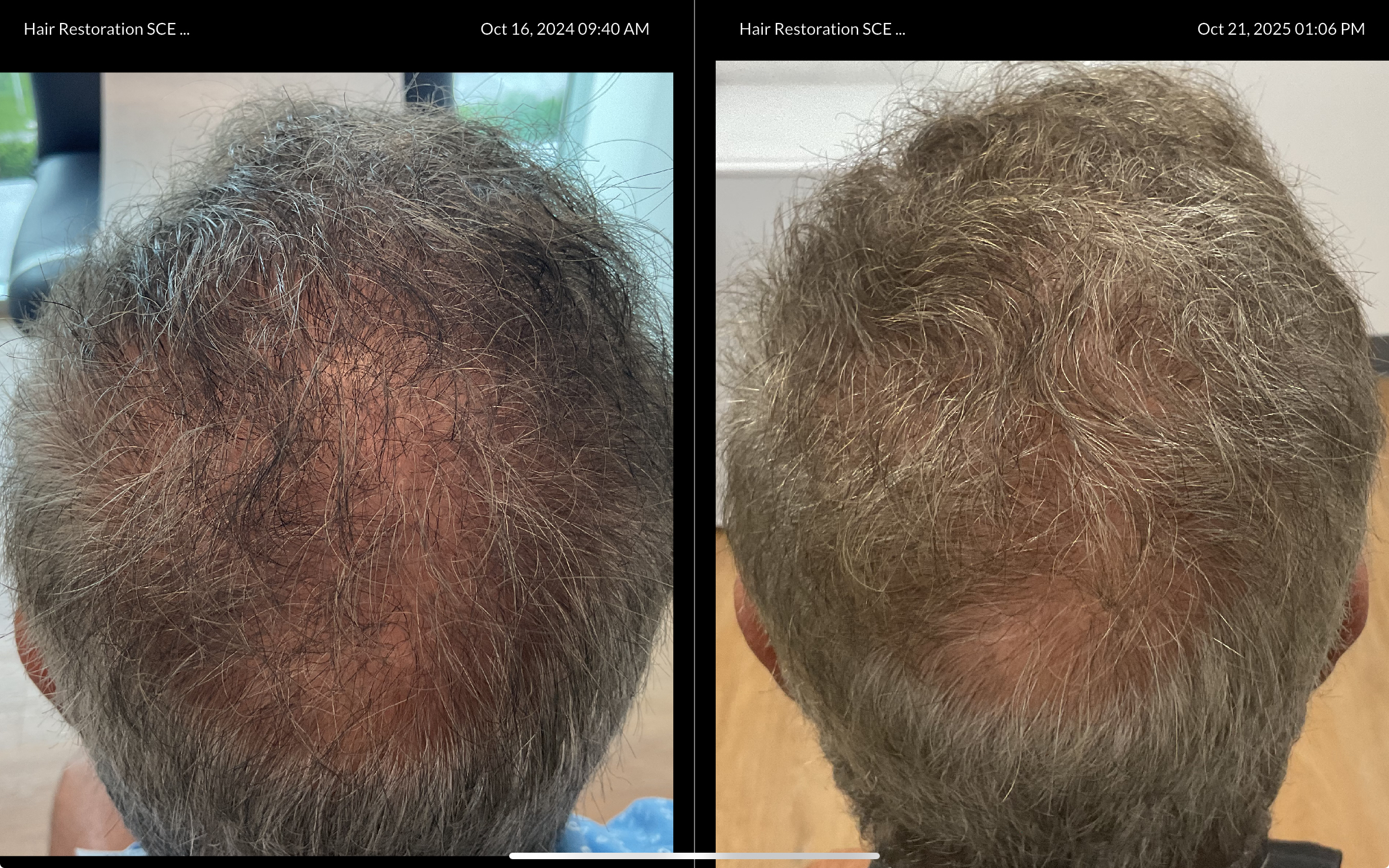 Hair Restoration Progress
